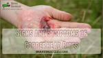 How Do You Treat a Copperhead Bite?